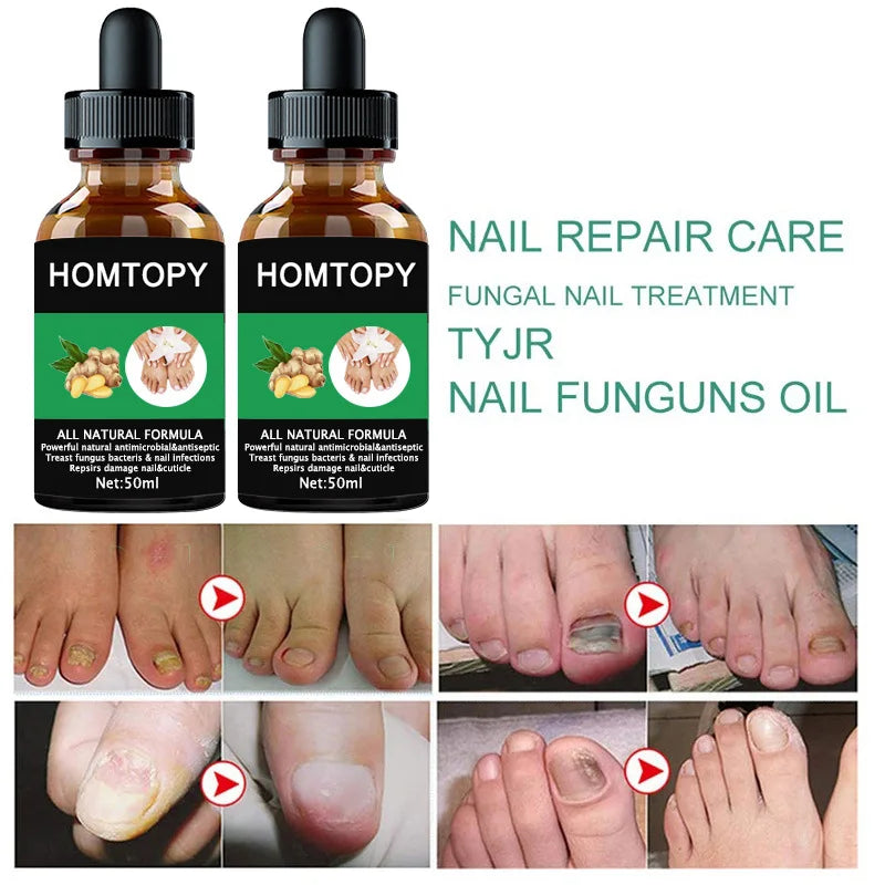 7 Days Nail Fungus Treatment Oil – Anti-Fungal Repair Serum