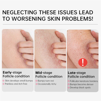 Body Whitening Cream – Keratosis Pilaris & Strawberry Legs Treatment