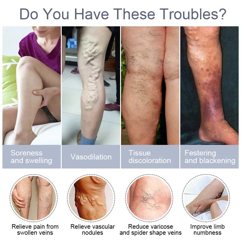 Varicose Vein Relief Cream – Spider Veins & Pain Treatment