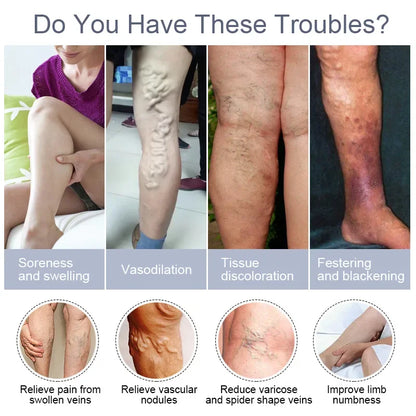 Varicose Vein Relief Cream – Spider Veins & Pain Treatment