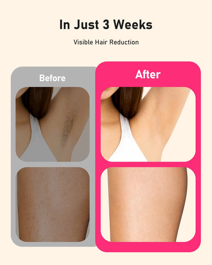 Laser Hair Removal 0.1S Flash 999,900+ 22J IPL Epilator