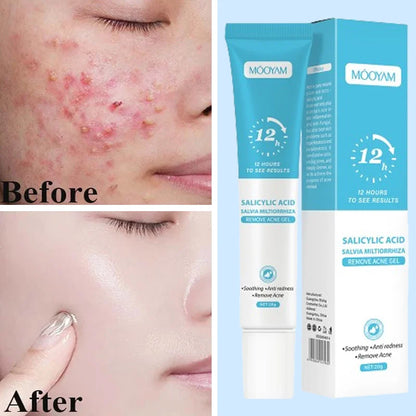Acne Treatment Cream – Pimple Remover & Pore Minimizer