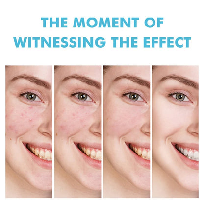 Acne Treatment Cream – Pimple Remover & Pore Minimizer