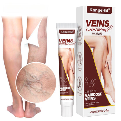Varicose Vein Relief Cream – Spider Veins & Pain Treatment