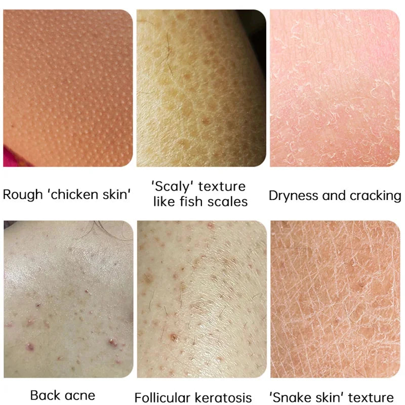 Body Whitening Cream – Keratosis Pilaris & Strawberry Legs Treatment