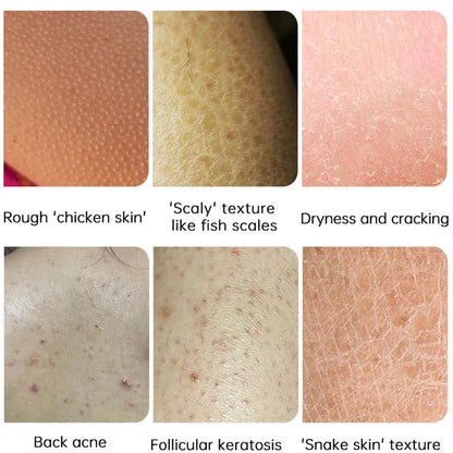 Body Whitening Cream – Keratosis Pilaris & Strawberry Legs Treatment