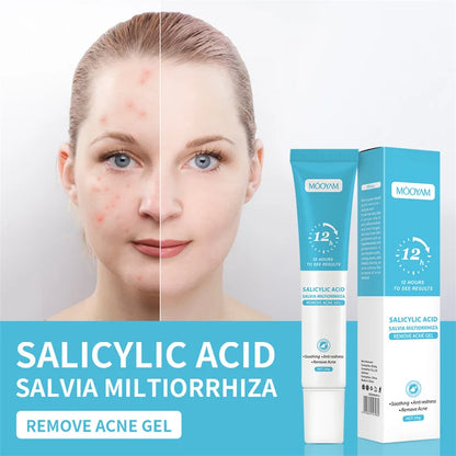 Acne Treatment Cream – Pimple Remover & Pore Minimizer