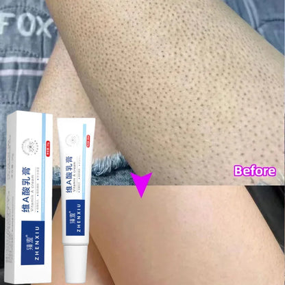 Body Whitening Cream – Keratosis Pilaris & Strawberry Legs Treatment