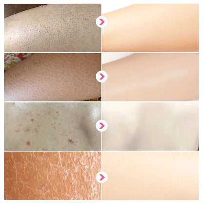 Body Whitening Cream – Keratosis Pilaris & Strawberry Legs Treatment