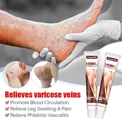Varicose Vein Relief Cream – Spider Veins & Pain Treatment