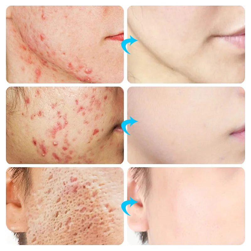 Acne Treatment Cream – Pimple Remover & Pore Minimizer