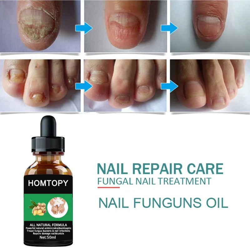 7 Days Nail Fungus Treatment Oil – Anti-Fungal Repair Serum