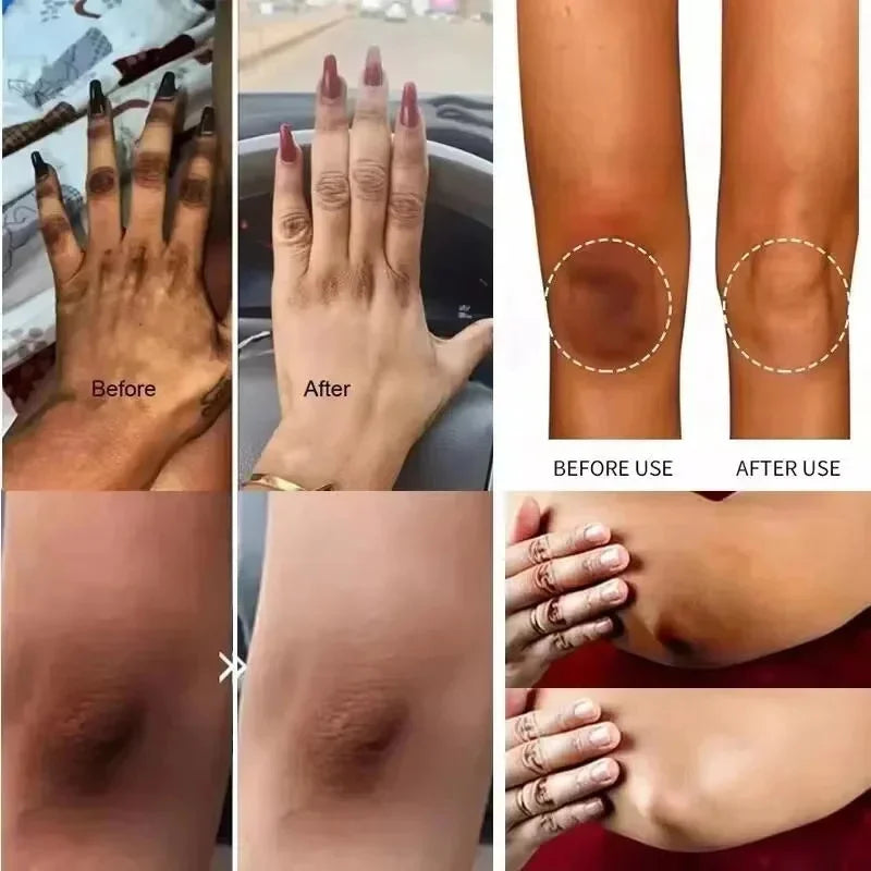 Body Whitening Cream – Intimate & Underarm Lightening