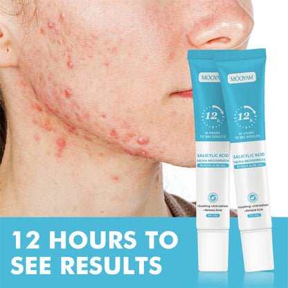 Acne Treatment Cream – Pimple Remover & Pore Minimizer