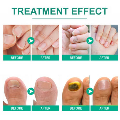 Extra Strong Nail Fungus Treatment – Toe & Nail Repair Oil