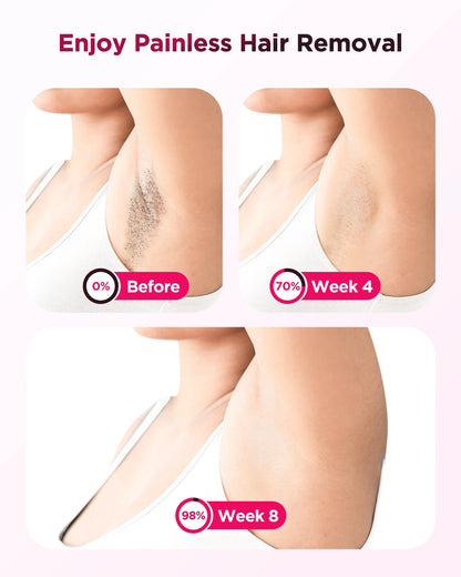 IPL Hair Removal Device
