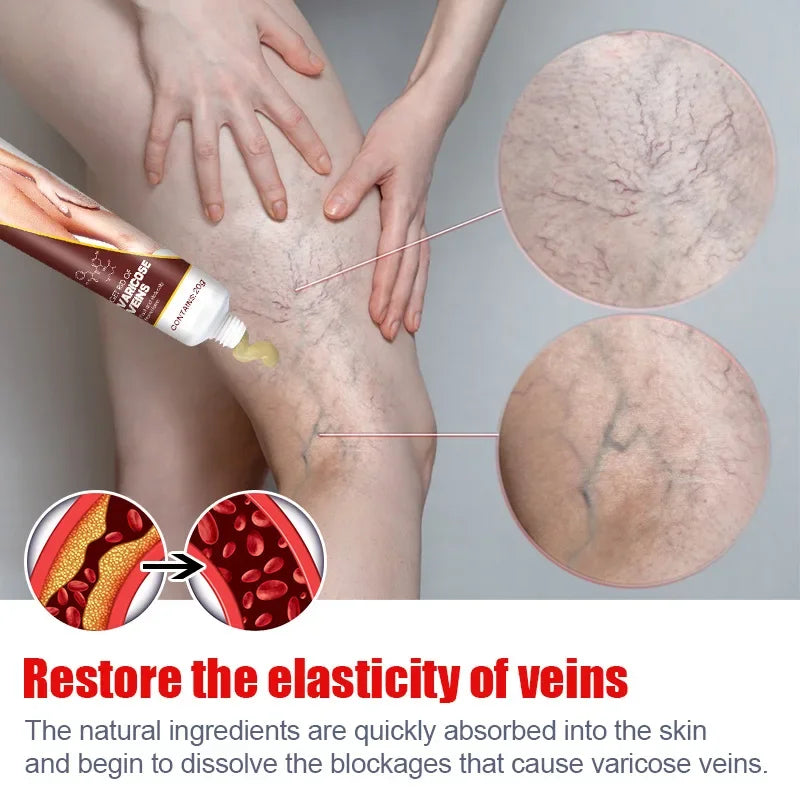 Varicose Vein Relief Cream – Spider Veins & Pain Treatment