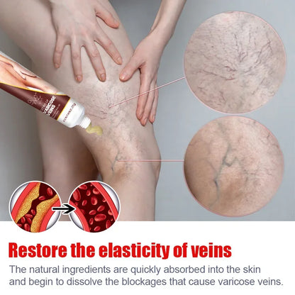 Varicose Vein Relief Cream – Spider Veins & Pain Treatment