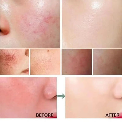 Anti-Redness Repair Cream – Rosacea & Spider Vein Treatment
