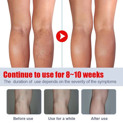 Varicose Vein Relief Cream – Spider Veins & Pain Treatment