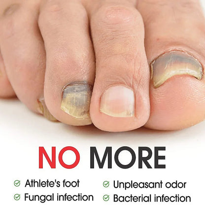 7 Days Nail Fungus Treatment Oil – Anti-Fungal Repair Serum