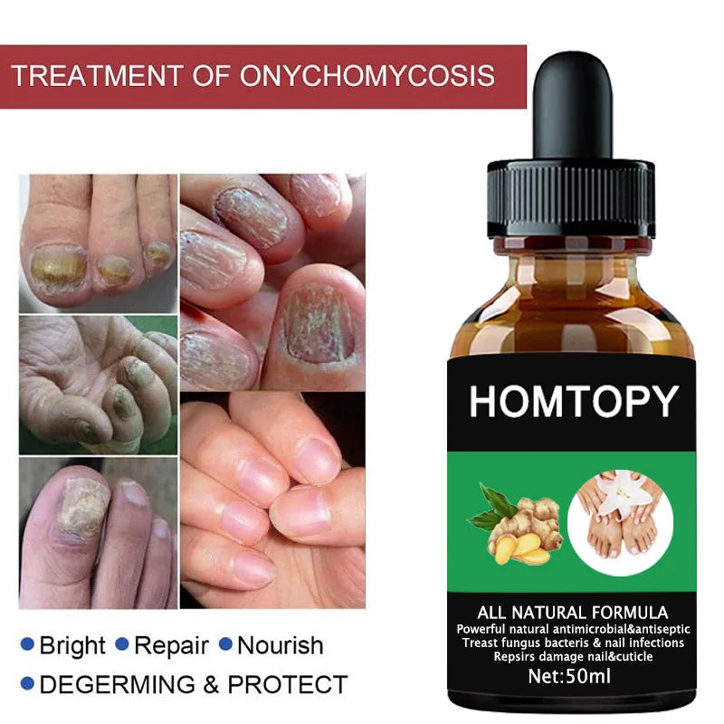 7 Days Nail Fungus Treatment Oil – Anti-Fungal Repair Serum