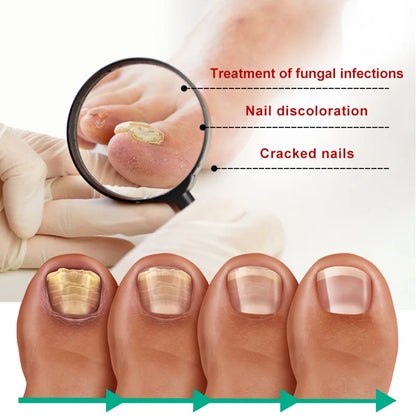 Extra Strong Nail Fungus Treatment – Toe & Nail Repair Oil